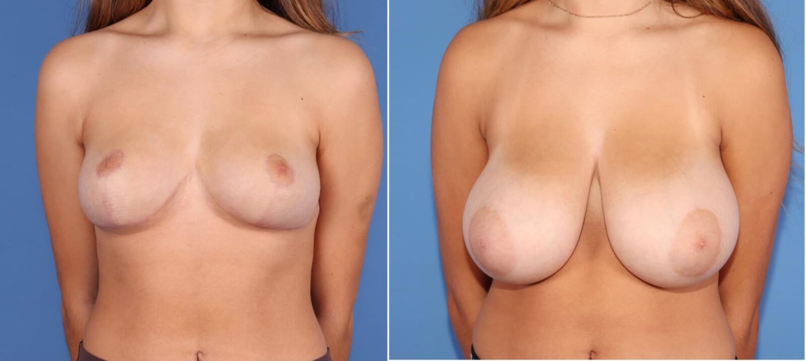 Pre Op Breast Reduction Collection 8