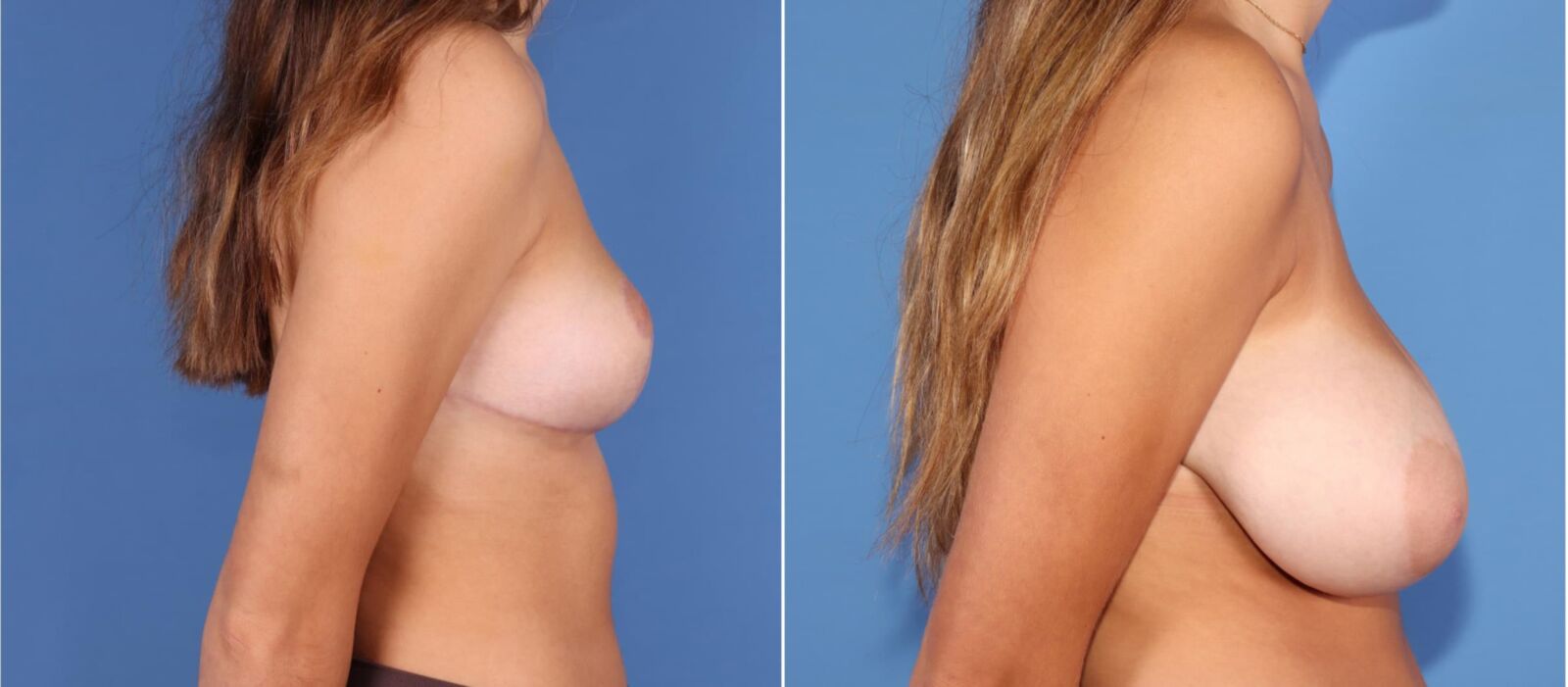 Pre Op Breast Reduction Collection 8