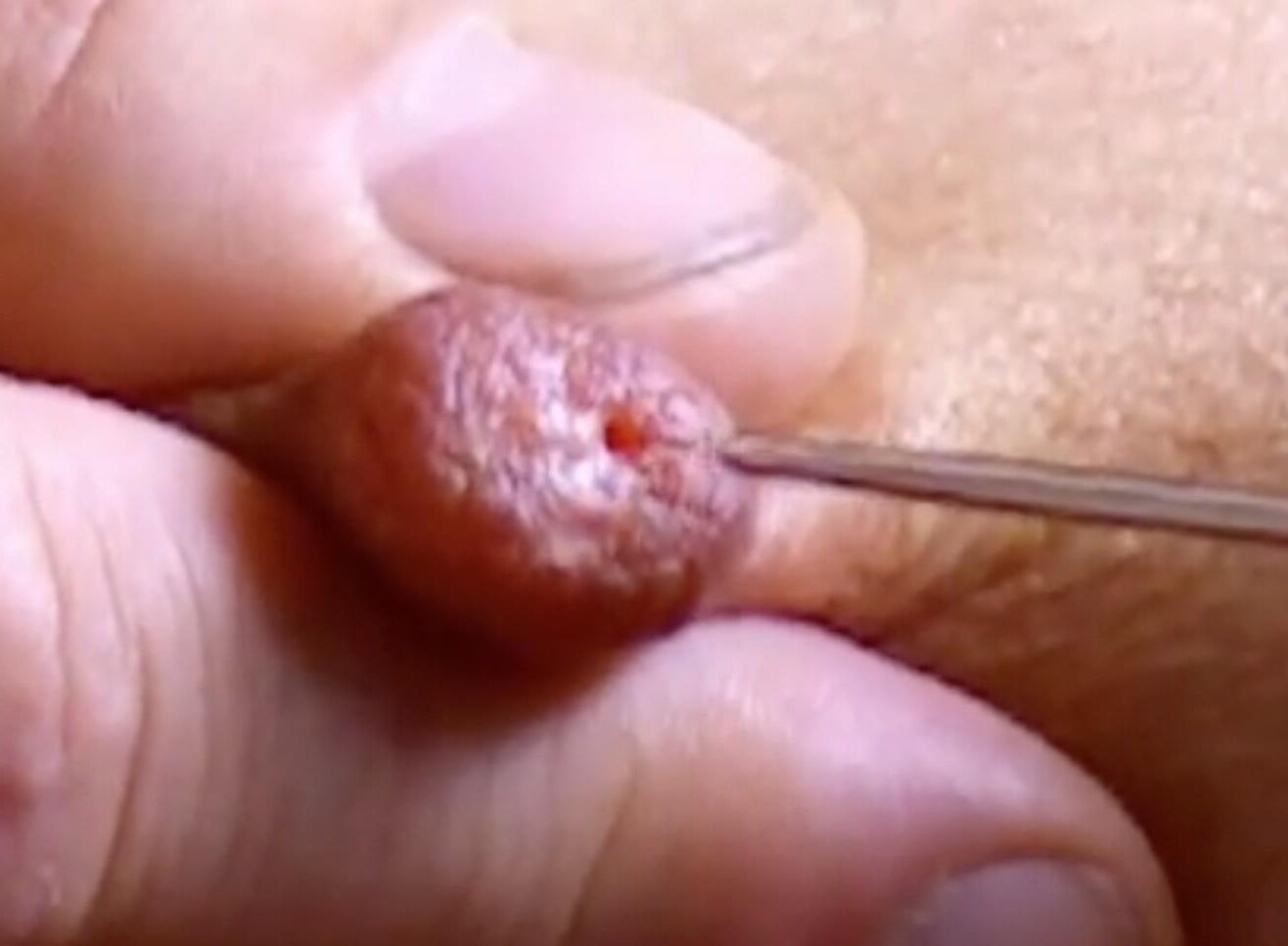 Inserting needles and skewers in nipples - making them inverted