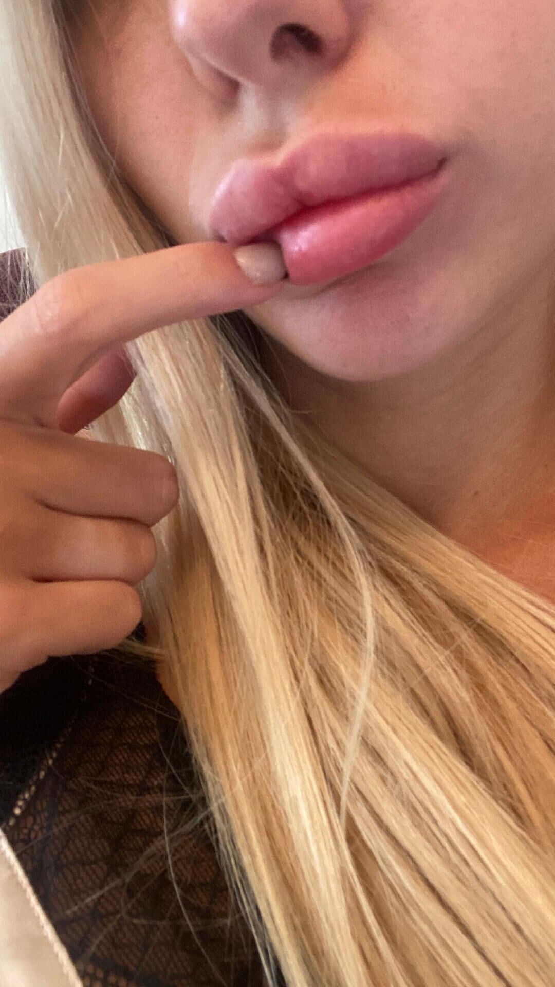 Josie loves lip filler and selling on Snap