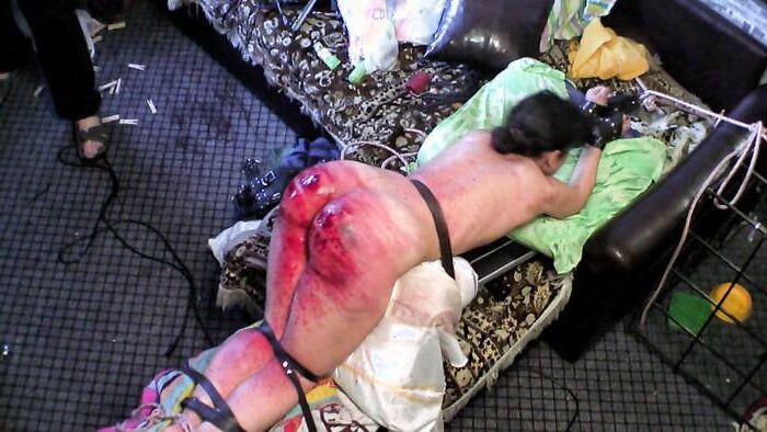 Beaten Bruised Buttocks 