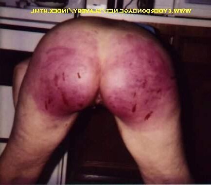 Beaten Bruised Buttocks 