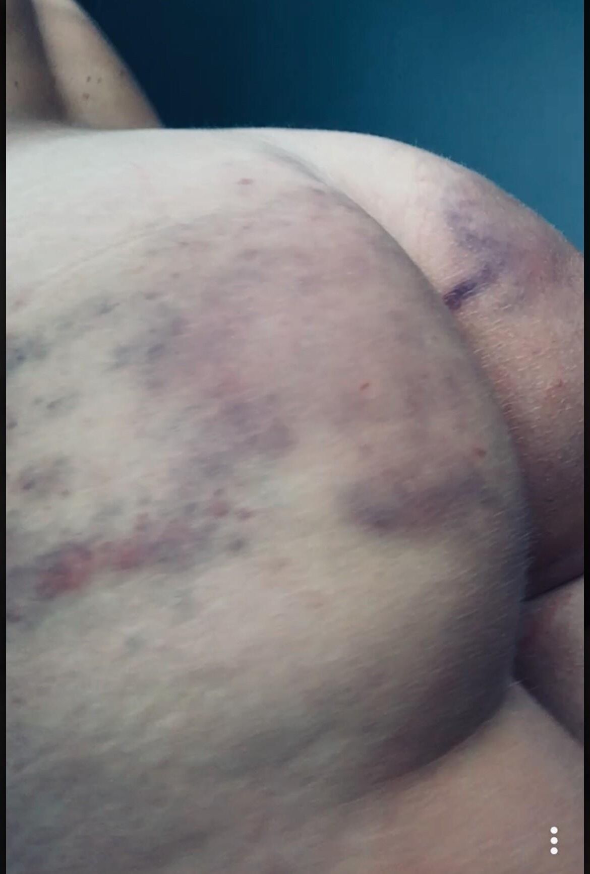 Beaten Bruised Buttocks 