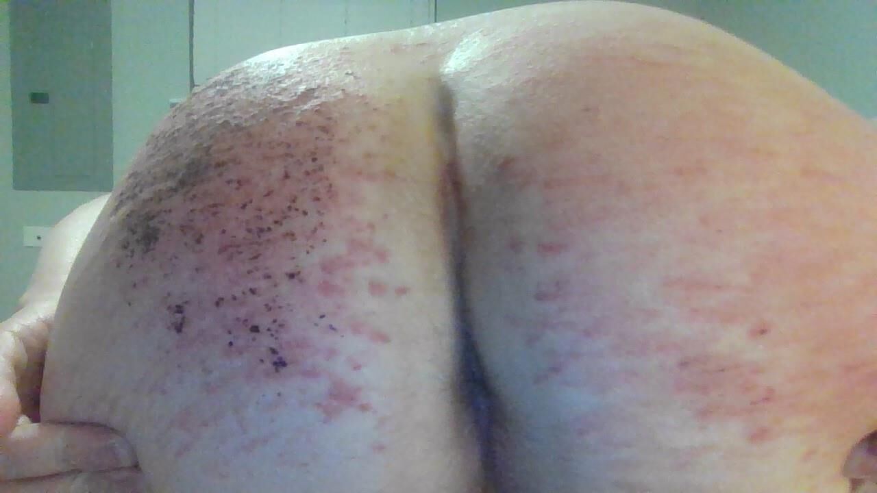 Beaten Bruised Buttocks 