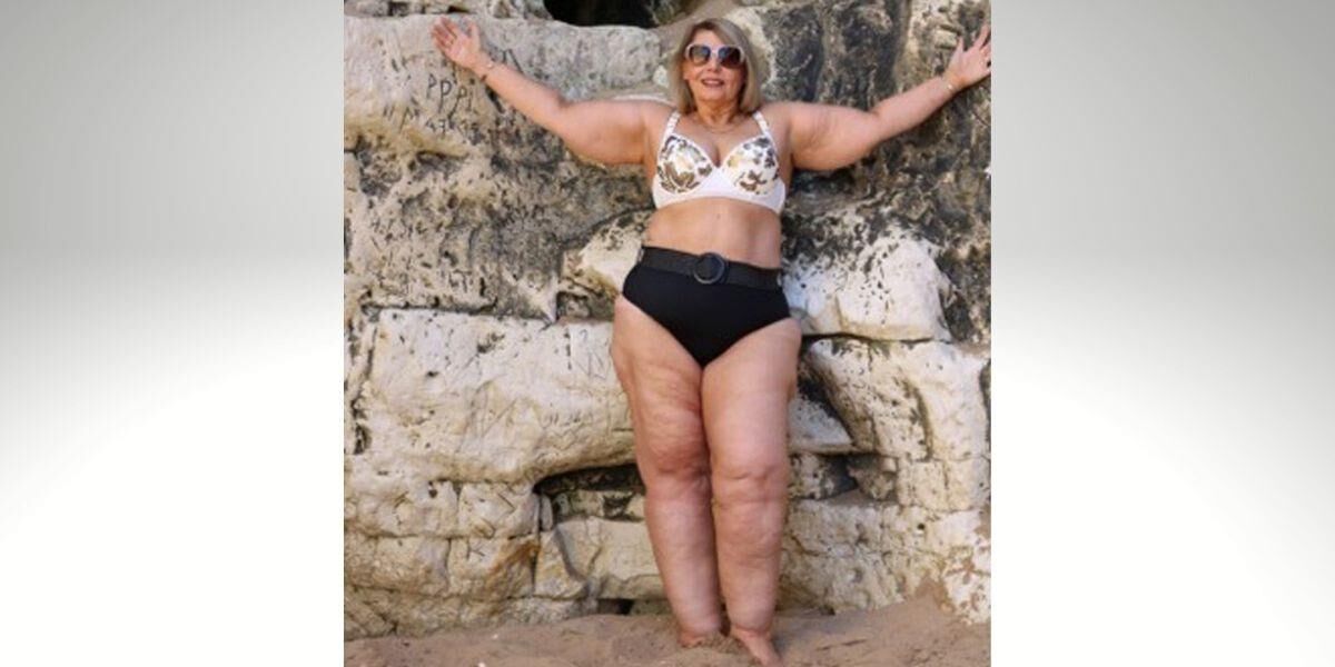 Piernas de celulitis de verano