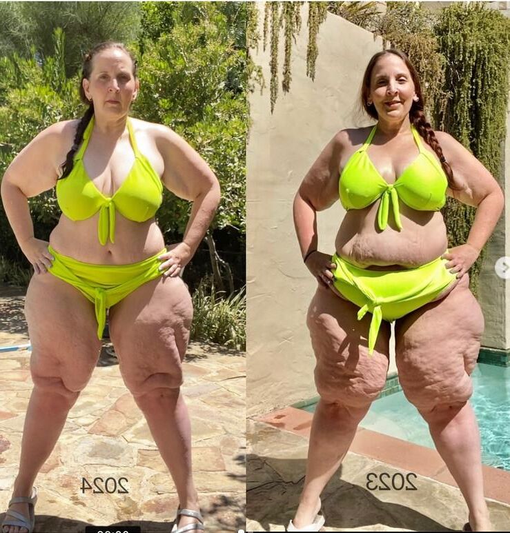 Piernas de celulitis de verano