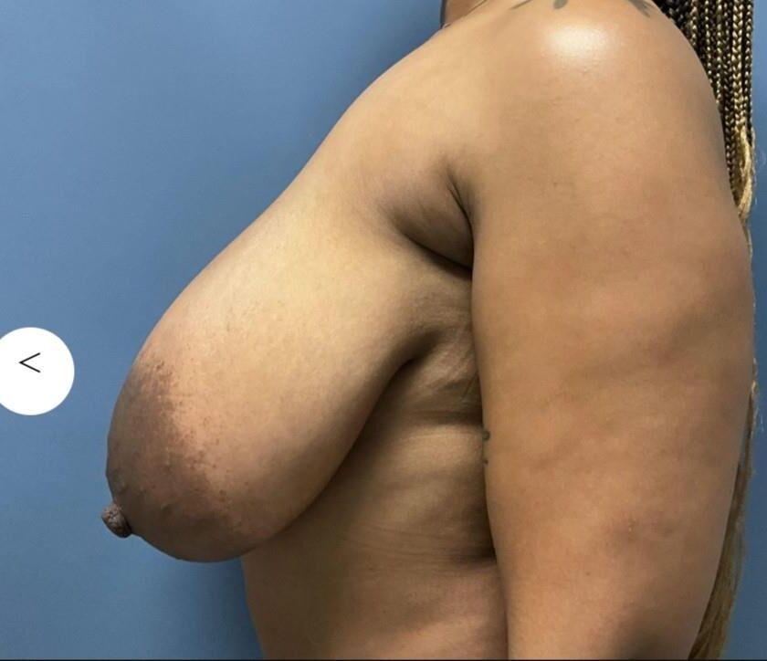 Peus preto pré -cirurgia
