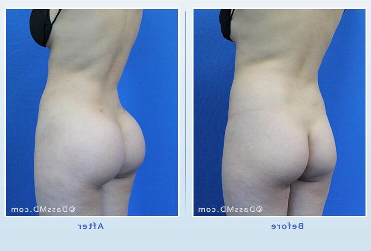 Vorchirurgie Arsch