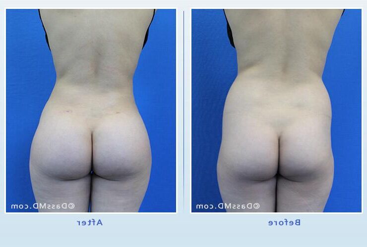 Vorchirurgie Arsch
