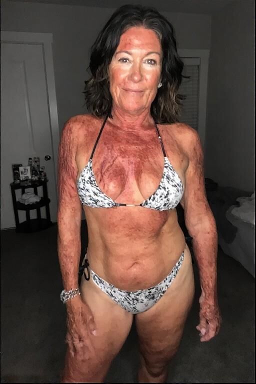 Birthmarks and Burn Scars