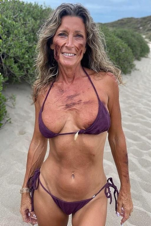 Birthmarks and Burn Scars
