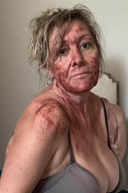 Birthmarks and Burn Scars