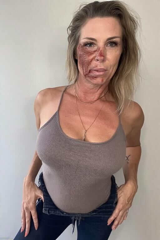 Birthmarks and Burn Scars