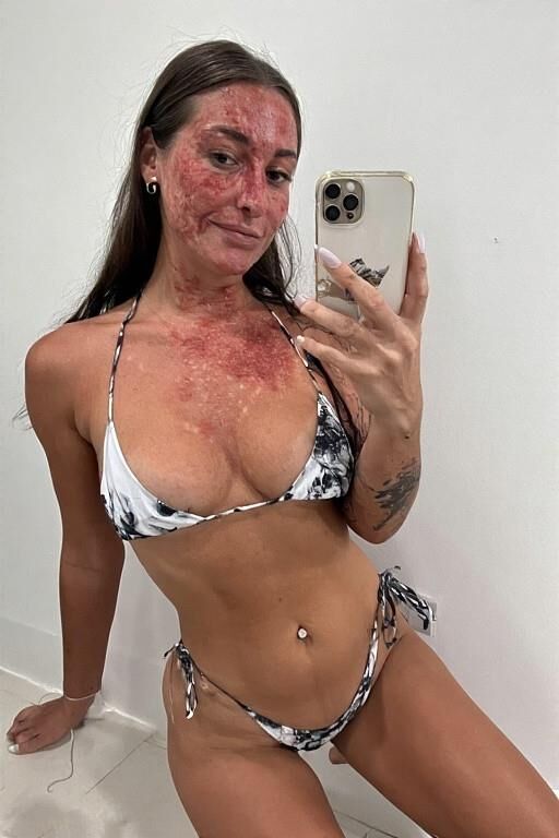 Birthmarks and Burn Scars