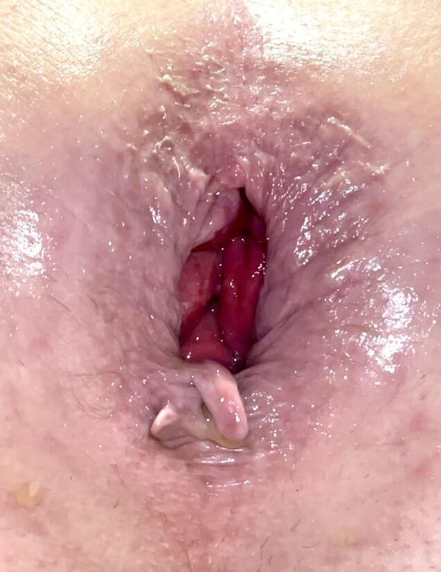 Meine Nahaufnahme anal Gape