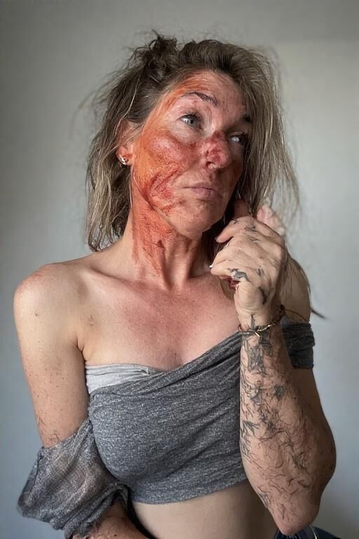 Birthmarks and Burn Scars