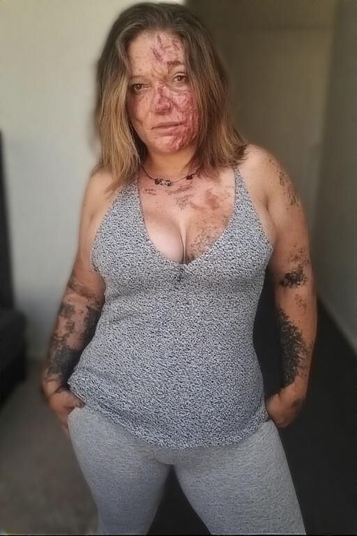 Birthmarks and Burn Scars