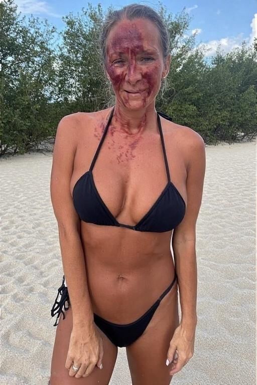 Birthmarks and Burn Scars