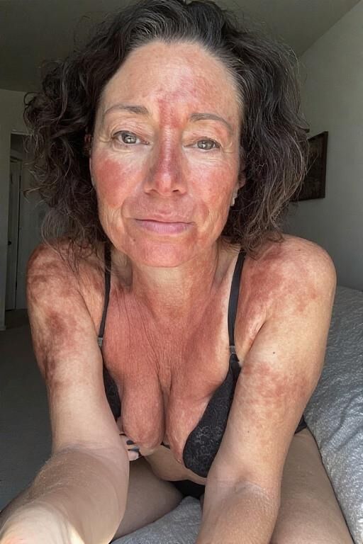 Birthmarks and Burn Scars