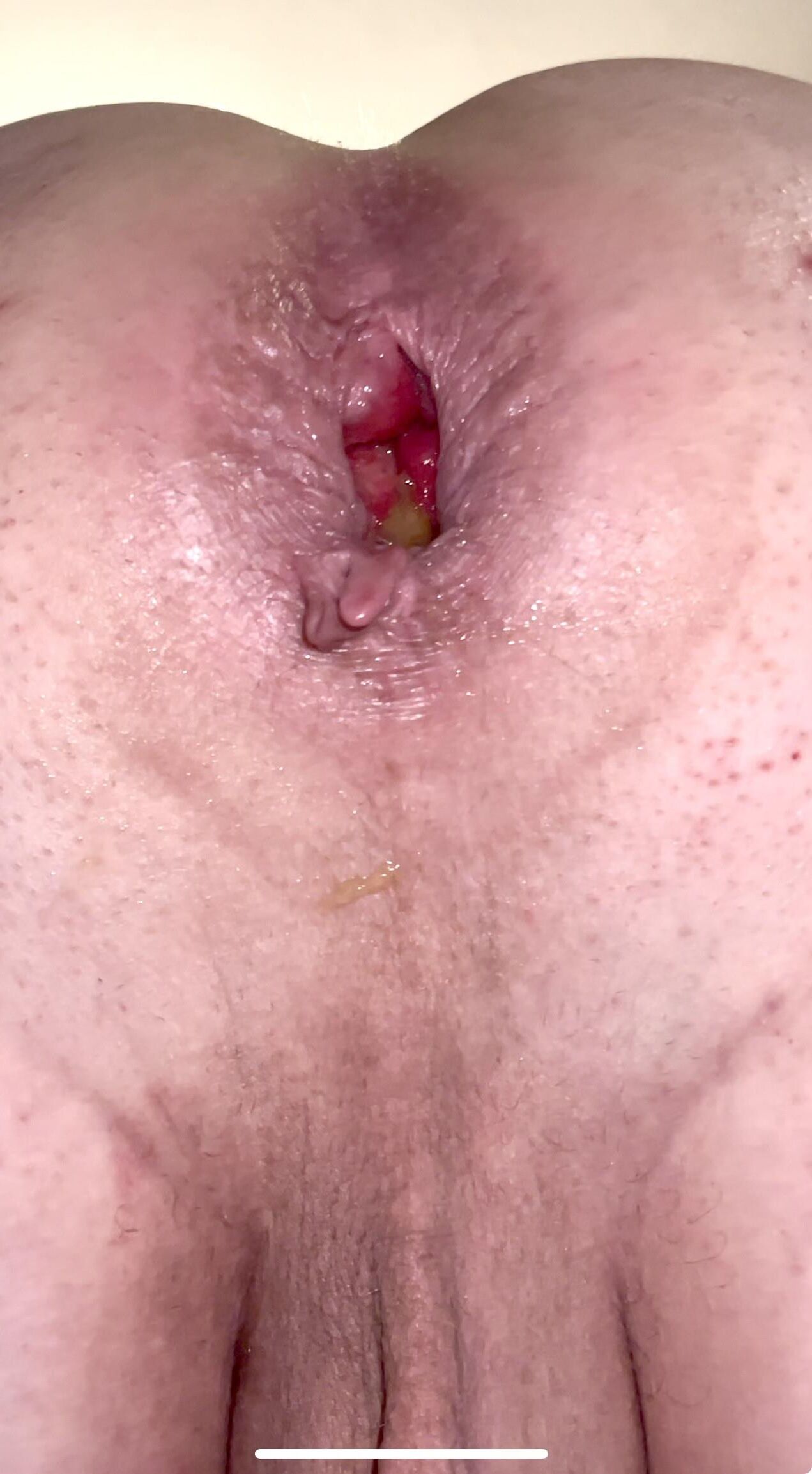 Mein weit offener analer Gape
