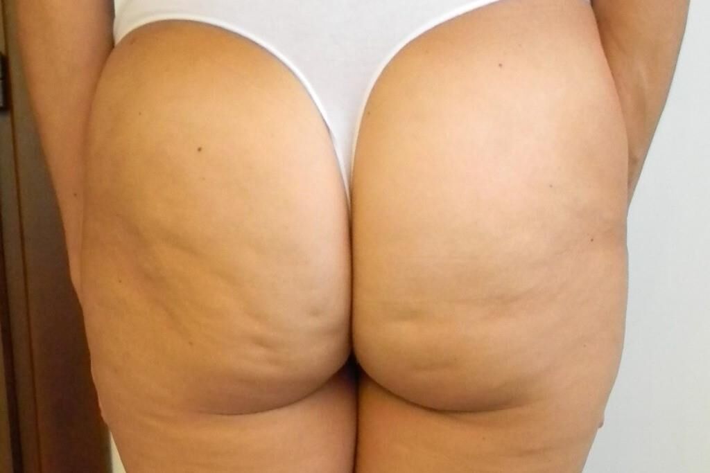 Cellulite Macht Geil