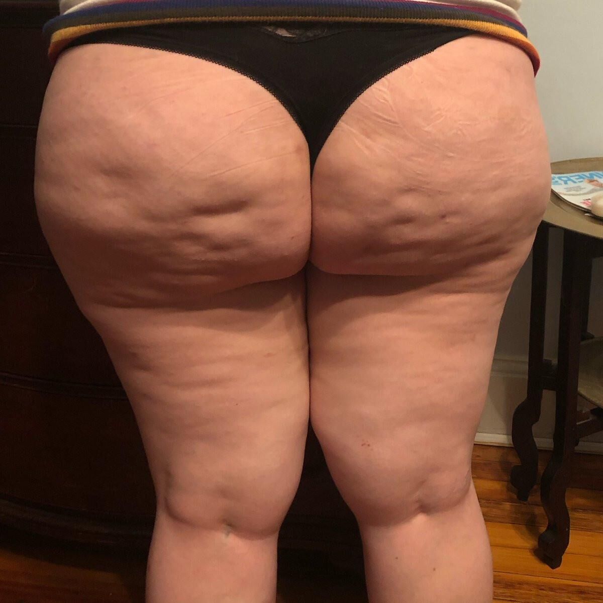 Cellulite Macht Geil